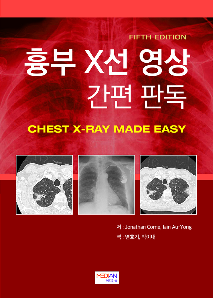 흉부 X선 영상 간편 판독