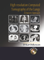 High-resolution Computed Tomography of the Lungs : A Pattern Approach