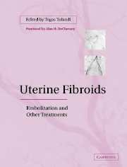 Uterine Fibroids : Embolization and Other Treatments