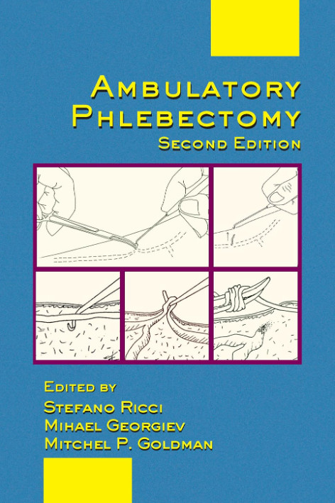 Ambulatory Phlebectomy(수술동영상 포함)