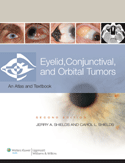 Rapidly identify eye tumors and choose optimal treatments : Eyelid Conjunctival and Orbital Tumors An Atals and  Text