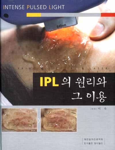 IPL의 원리와 그 이용