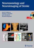 Neurosonology and Neuroimaging of Stroke Book and DVD