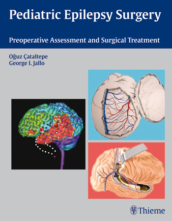 Pediatric Epilepsy Surgery: Preoperative Assessment and Surgical Treatment