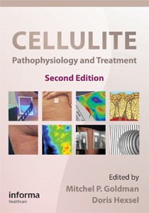 Cellulite: Pathophysiology and Treatment-2판
