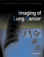 Imaging of Lung Cancer