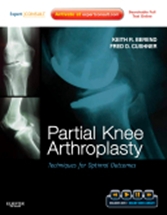 Partial Knee Arthroplasty:Techniques for Optimal Outcomes