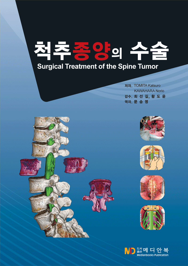 척추종양의 수술 Surgical Treatment of the Spine Tumor