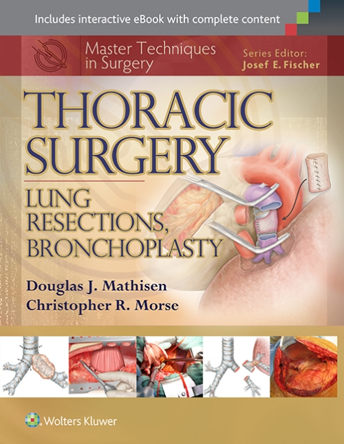Master Techniques in Surgery: Thoracic Surgery: Lung Resections Bronchoplasty