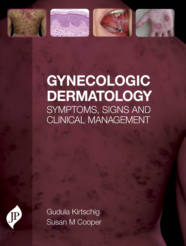 Gynecologic Dermatology: Symptoms Signs and Clinical Management