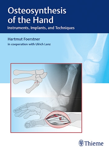 Osteosynthesis of the Hand Instruments Implants and Techniques
