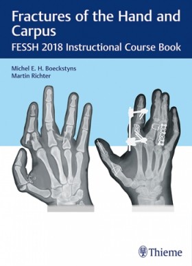 Fractures of the Hand and Carpus-1판