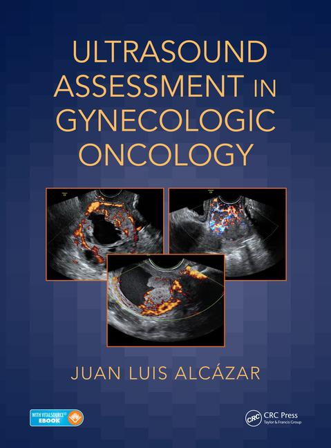 Ultrasound Assessment in Gynecologic Oncology-1판