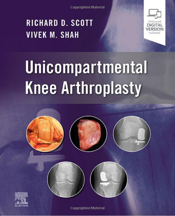 Unicompartmental Knee Arthroplasty-1판