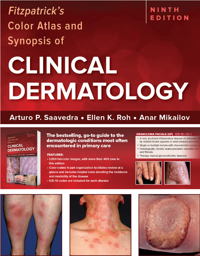 Fitzpatrick`s Color Atlas and Synopsis of Clinical Dermatology-9판