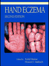 Hand Eczema-2판(2000)